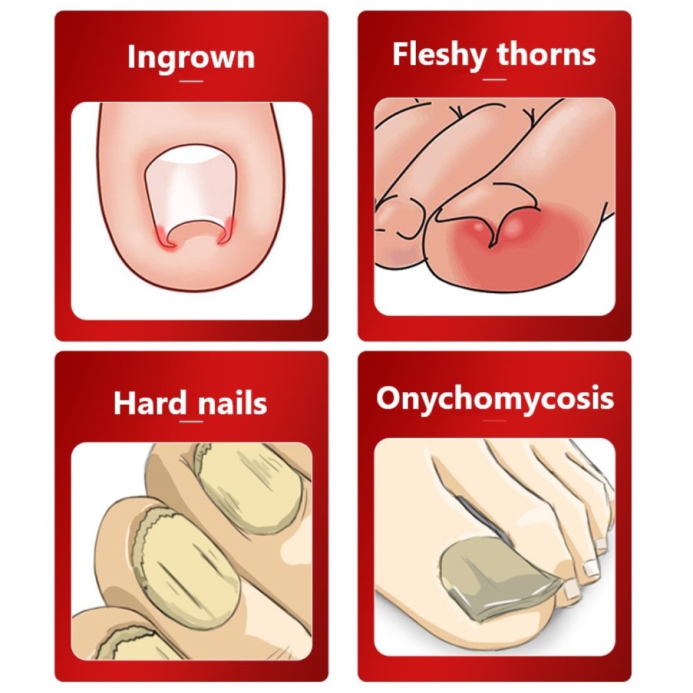 Dead Skin Dirt Remover Pedicure Care Tool Pro with stainless steel blade and ergonomic ABS handle, ideal for trimming cuticles and dead skin.