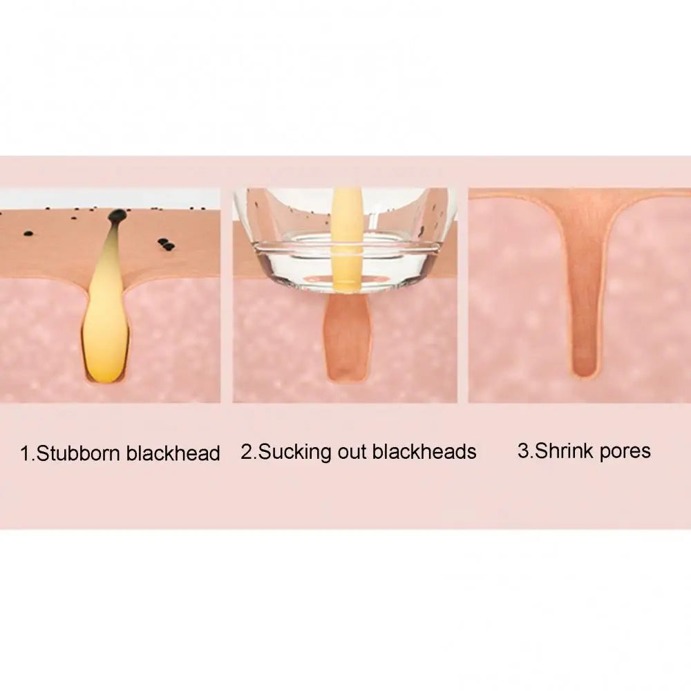 Blackhead Remover Pore Vacuum Cleaner with multiple suction heads and USB charging cable, designed for effective skin care.