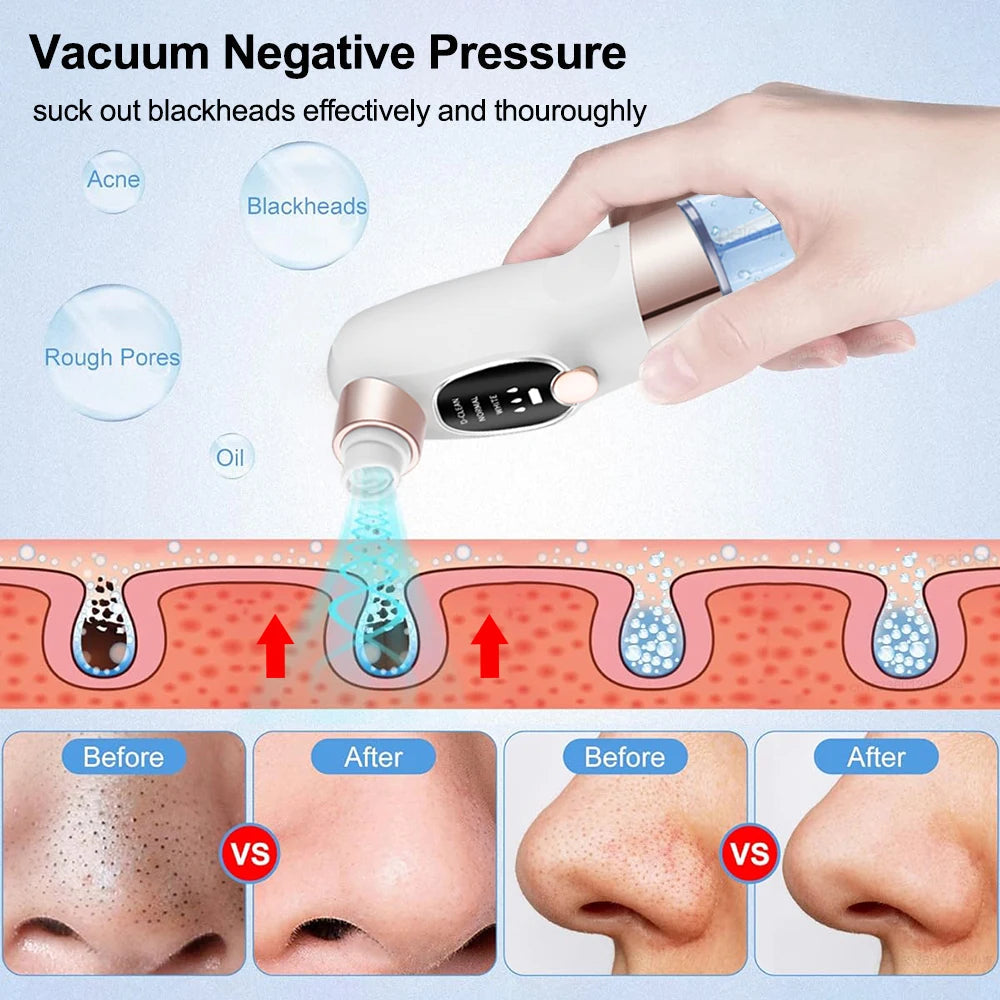 Electric Blackhead Remover Pore Vacuum Cleaner with multiple suction heads for effective blackhead and acne removal.