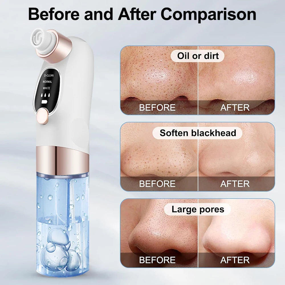 Electric Blackhead Remover Pore Vacuum Cleaner with multiple suction heads for effective blackhead and acne removal.