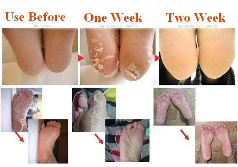 Baby Foot Peeling Renewal Foot Mask package containing 3 packs and 6 pieces of foot masks designed for dead skin removal.
