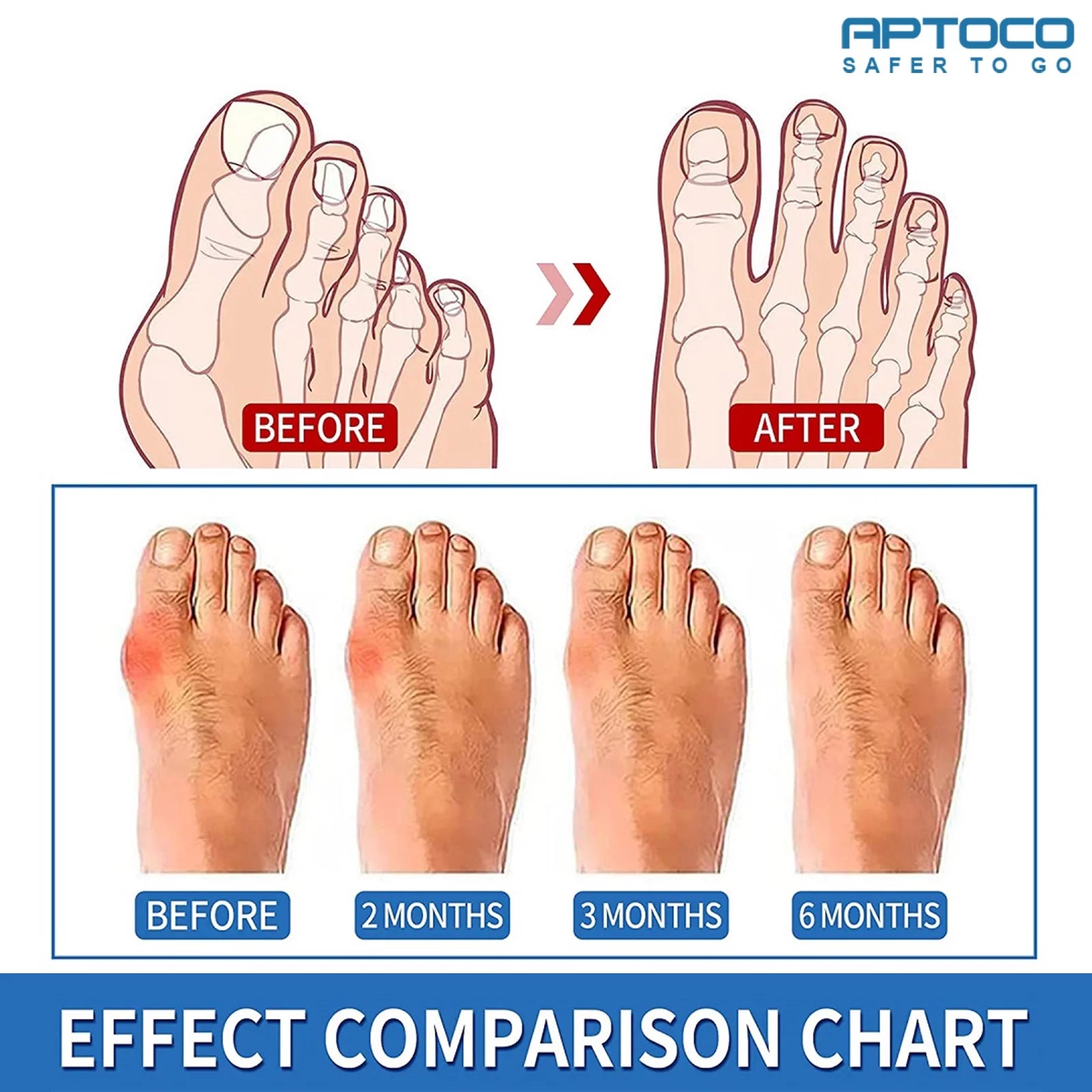 Copper Bunion Corrector featuring gel pads and copper-infused fabric, designed for hallux valgus support.