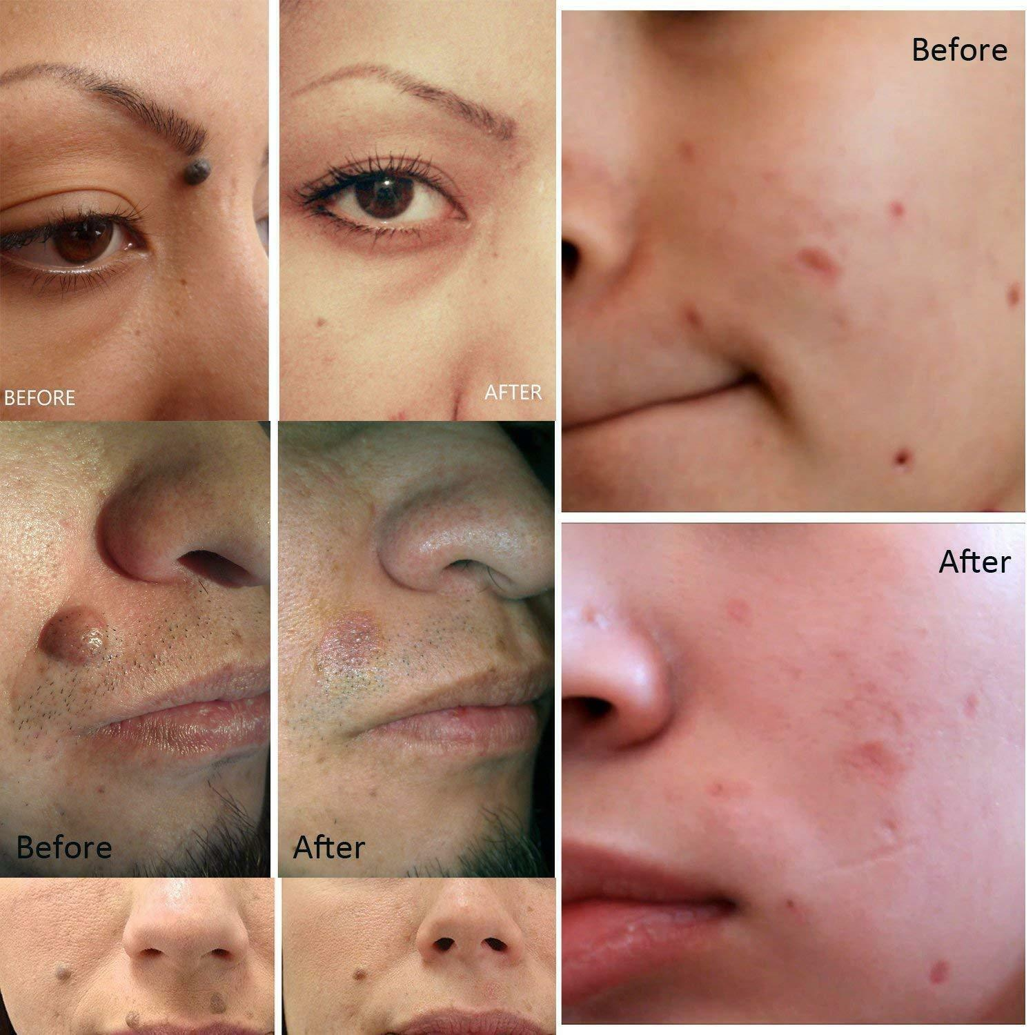 Electric Laser Plasma Pen for mole and dark spot removal, featuring a sleek white design and ergonomic shape for easy handling.